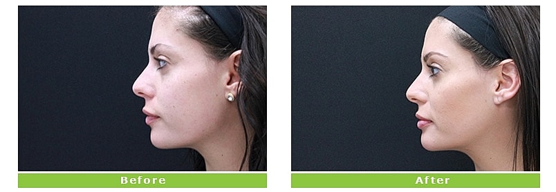 Before and after profile view of facial change