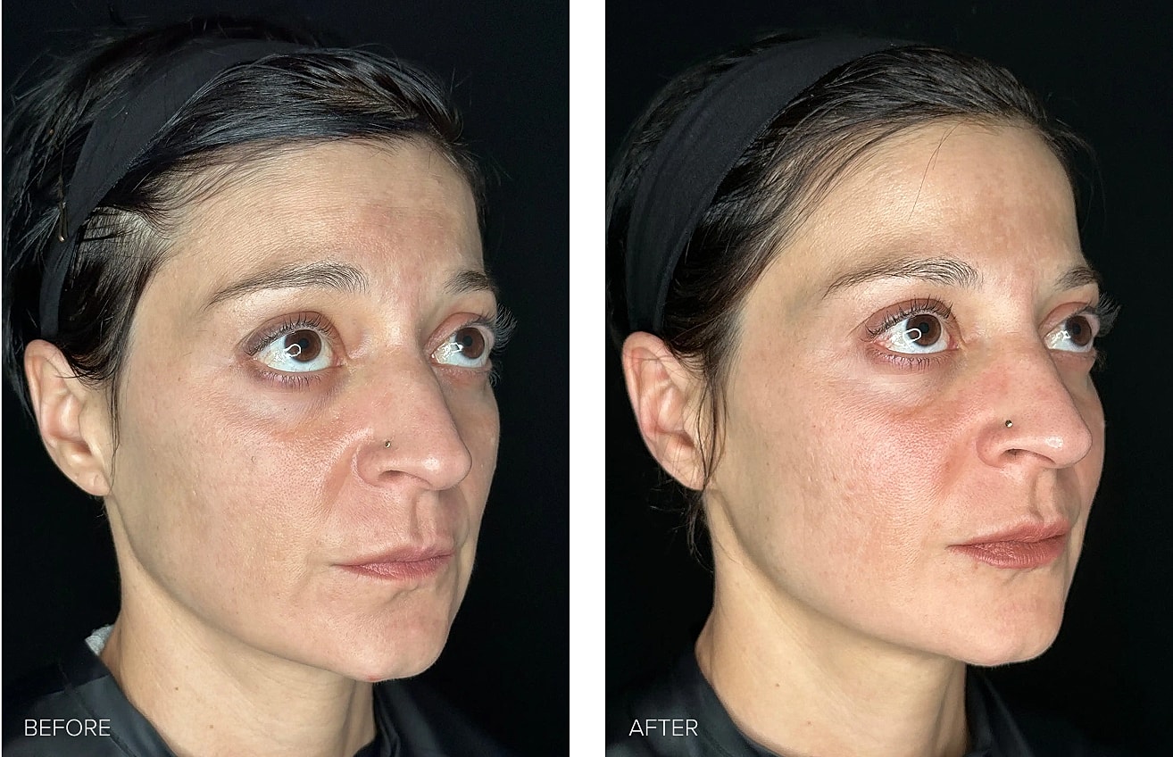Before and after skincare treatment comparison.