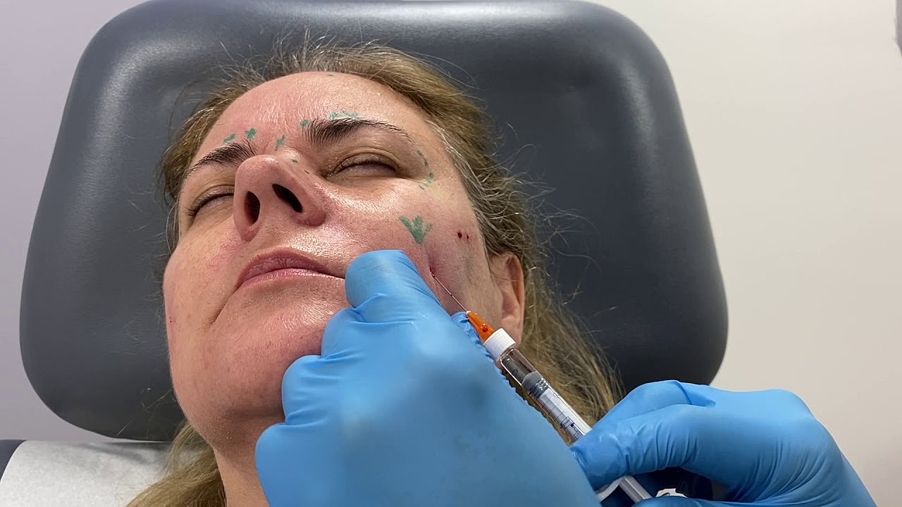 Cosmetic treatment with syringe and markings on face.