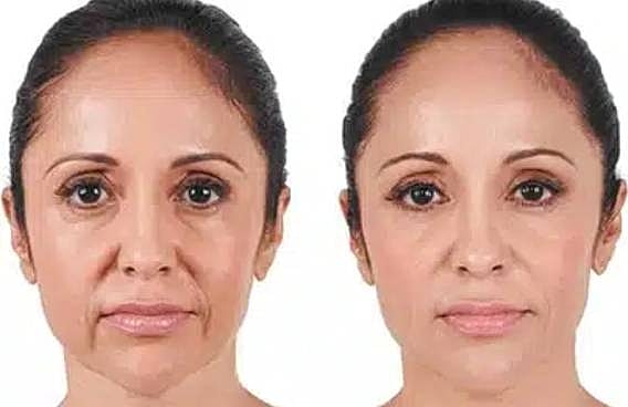 Before and after facial rejuvenation treatment comparison.
