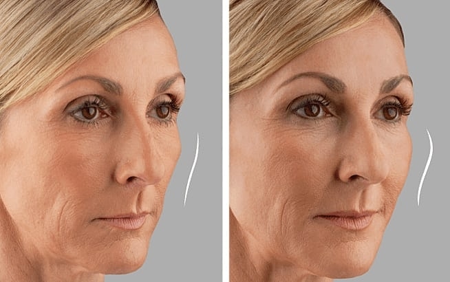 Before and after skin treatment comparison.