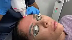 Person receiving laser treatment for skin care.