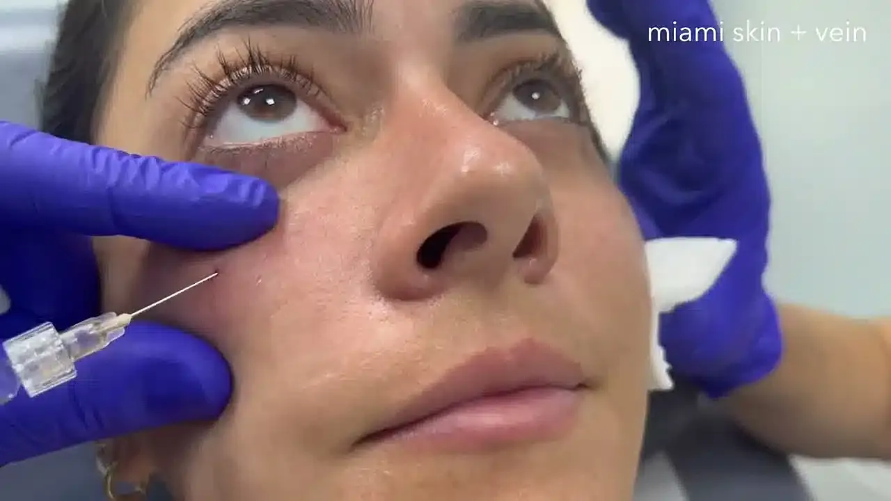 Skin treatment procedure with syringe and gloves.