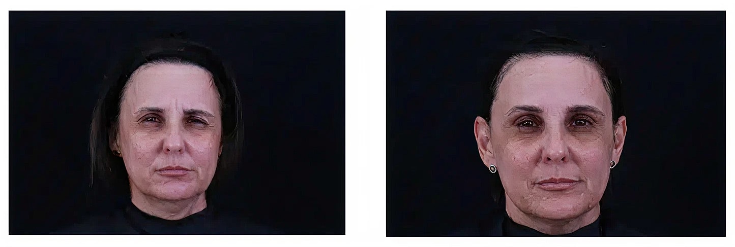 Before and after facial treatment comparison images.