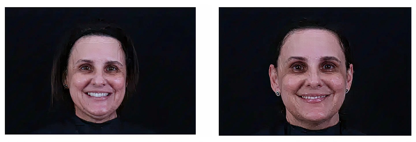 Before and after facial treatment comparison image