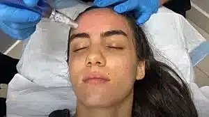 Facial treatment using a microneedling device.
