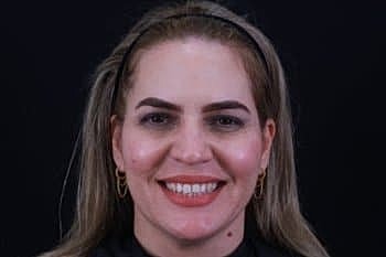 Dermal Fillers Before & After