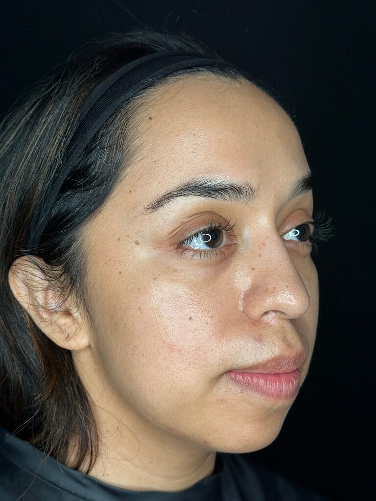 Dermal Fillers Before & After