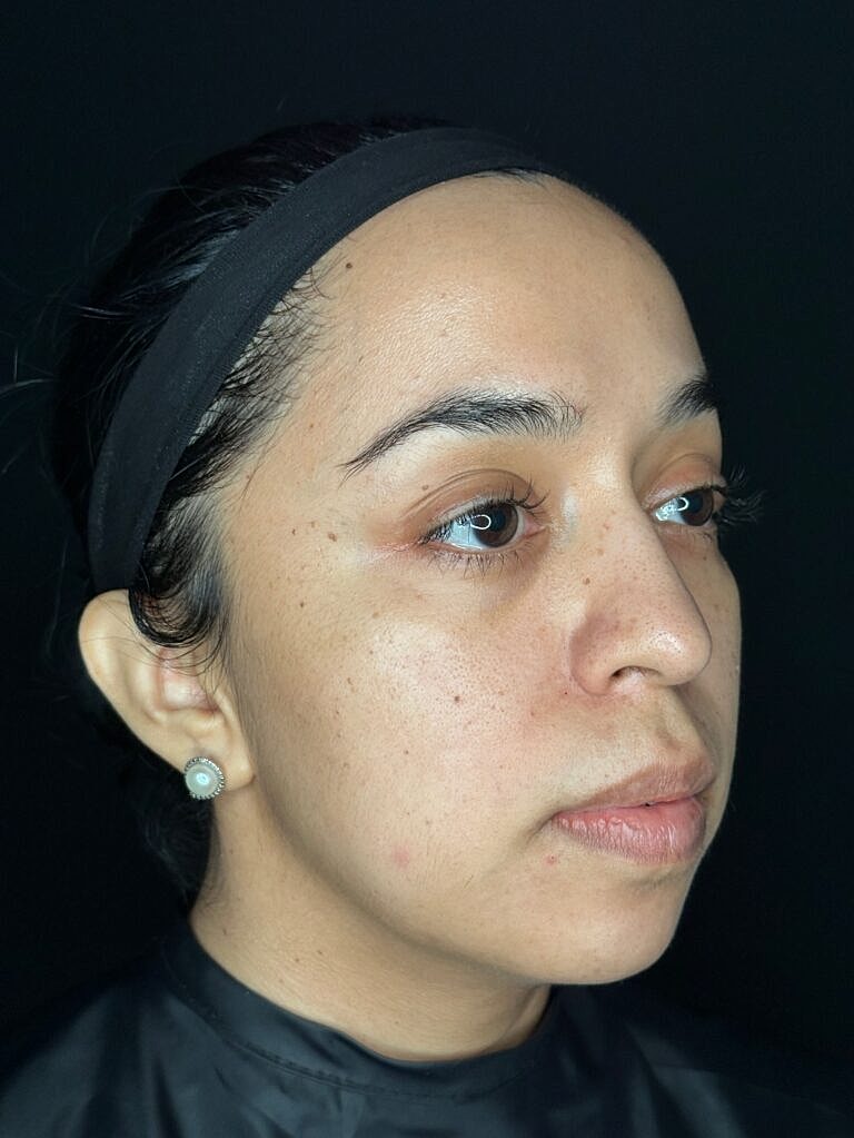 Dermal Fillers Before & After