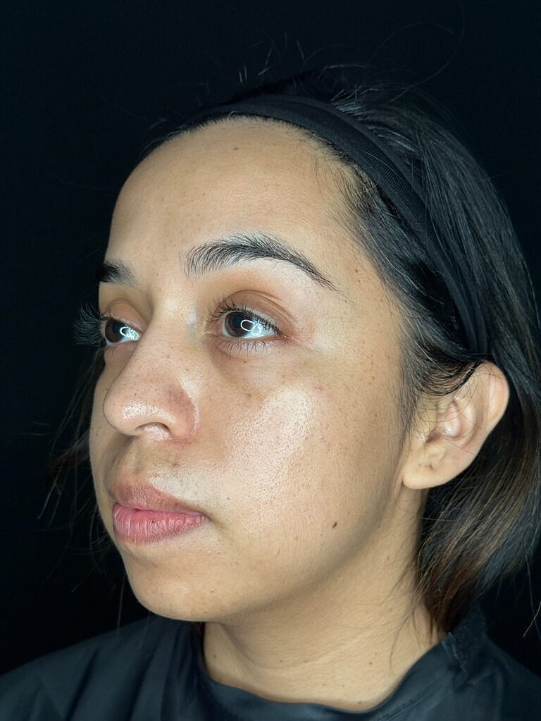 Dermal Fillers Before & After