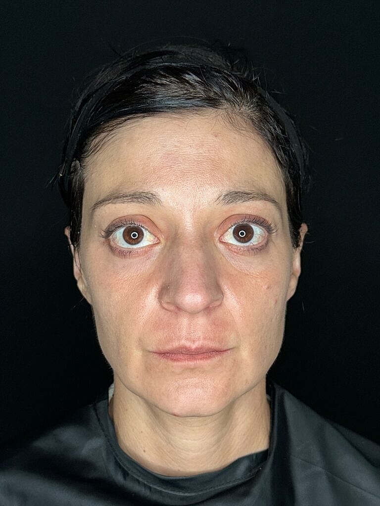 Dermal Fillers Before & After