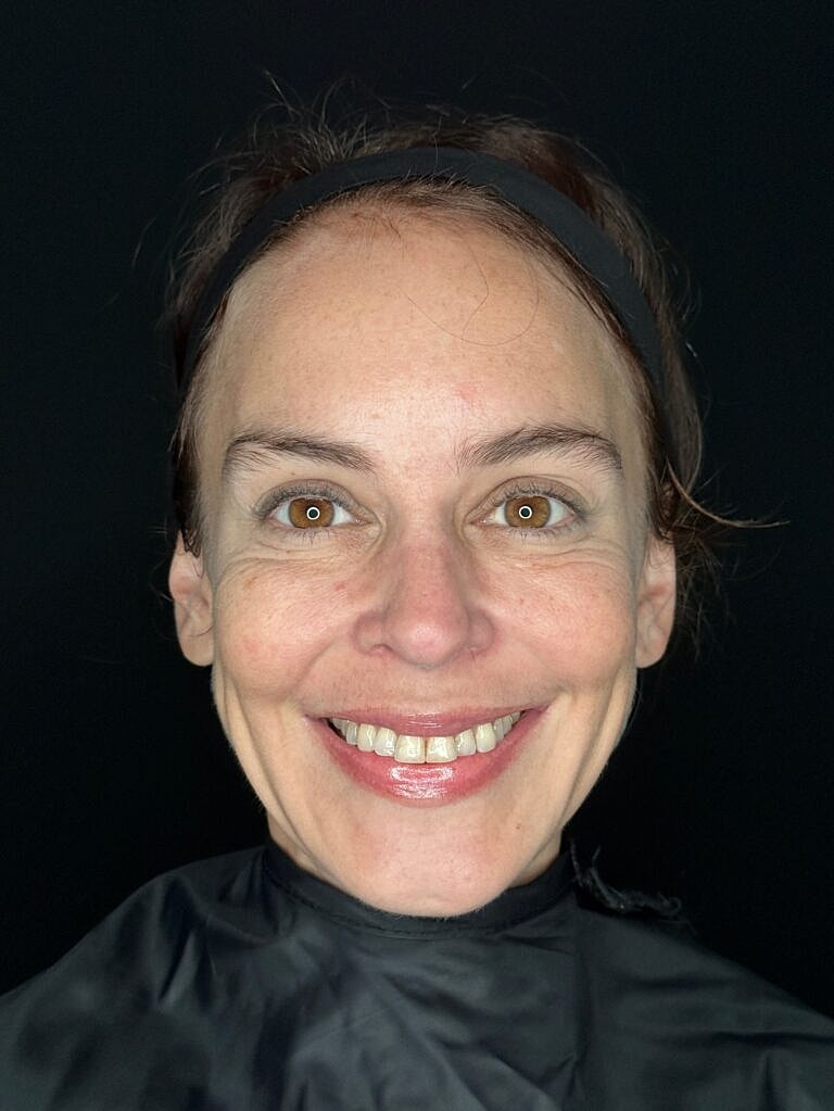 Dermal Fillers Before & After