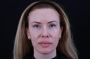 Dermal Fillers Before & After