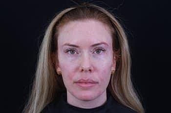 Dermal Fillers Before & After