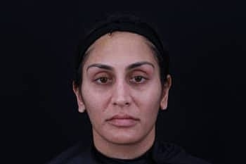 Dermal Fillers Before & After