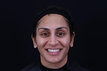 Dermal Fillers Before & After