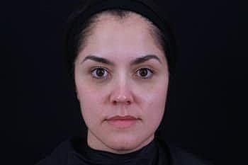 Dermal Fillers Before & After