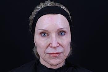 Dermal Fillers Before & After