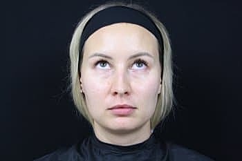 Dermal Fillers Before & After