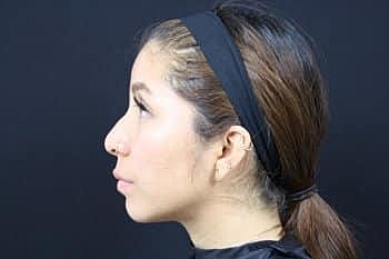 Dermal Fillers Before & After