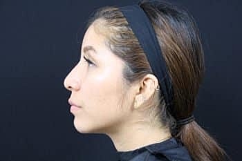 Dermal Fillers Before & After