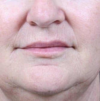 Dermal Fillers Before & After