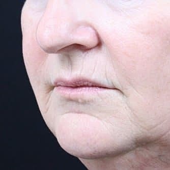 Dermal Fillers Before & After