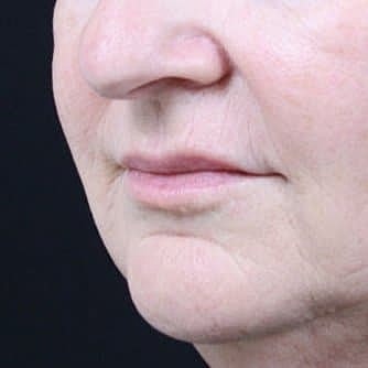 Dermal Fillers Before & After