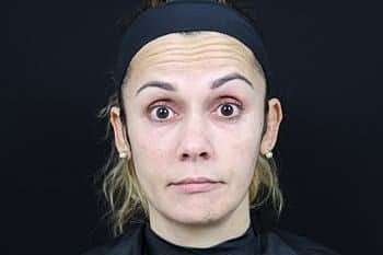 Dermal Fillers Before & After