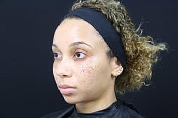 Dermal Fillers Before & After