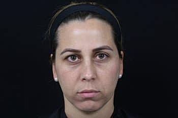 Dermal Fillers Before & After