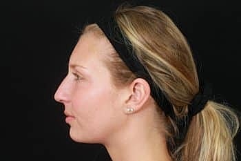 Dermal Fillers Before & After