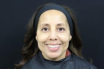 Dermal Fillers Before & After