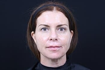 Dermal Fillers Before & After