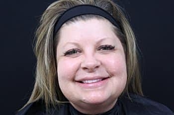 Dermal Fillers Before & After