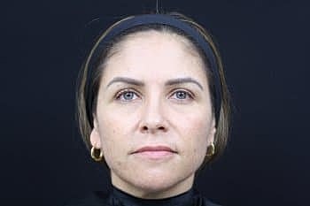 Dermal Fillers Before & After