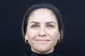 Dermal Fillers Before & After