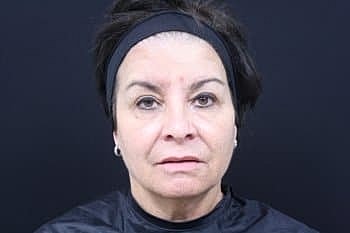 Dermal Fillers Before & After