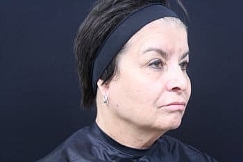 Dermal Fillers Before & After