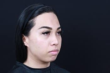 Dermal Fillers Before & After