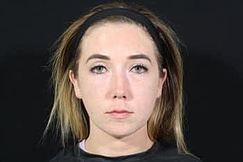 Dermal Fillers Before & After