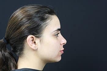 Dermal Fillers Before & After