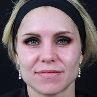 Dermal Fillers Before & After