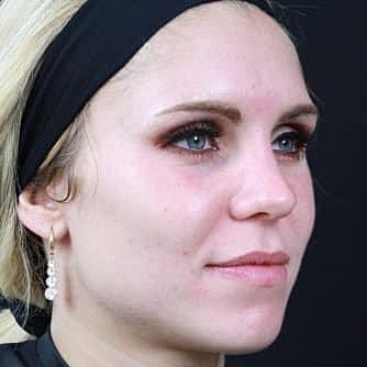 Dermal Fillers Before & After