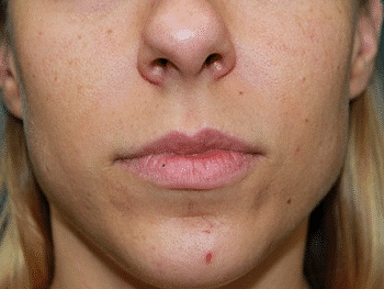 Dermal Fillers Before & After