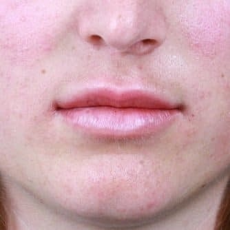 Dermal Fillers Before & After