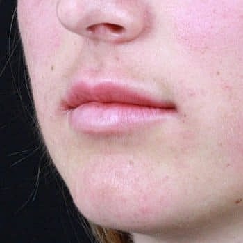 Dermal Fillers Before & After