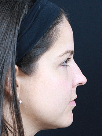 Dermal Fillers Before & After
