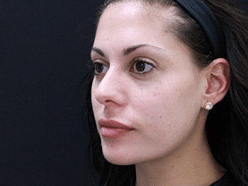 Dermal Fillers Before & After