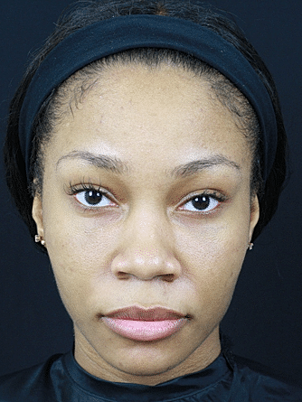 Dermal Fillers Before & After